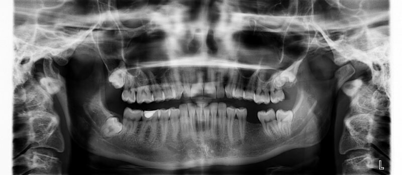 When You Lose A Tooth, You Often Lose A Lot More – Get Dental Implants Today